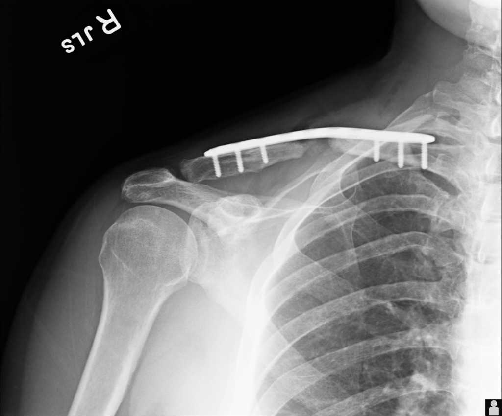 clavicle1_6weeks.jpg