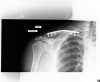 clavicle1_26weeks_resize.jpg